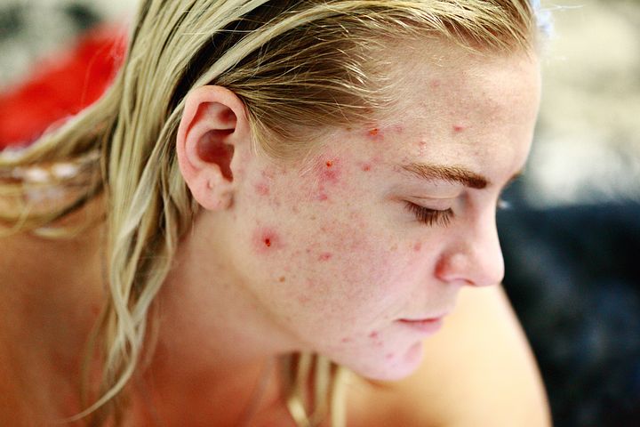 Acne-1