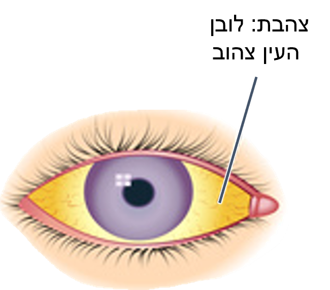 jaundice eye