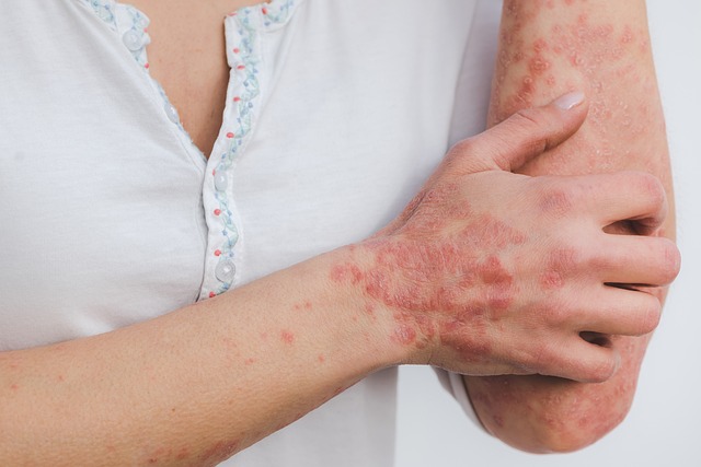 psoriasis-1