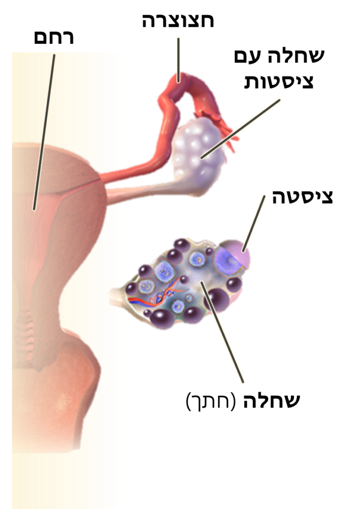 Ovary w cyst cutout