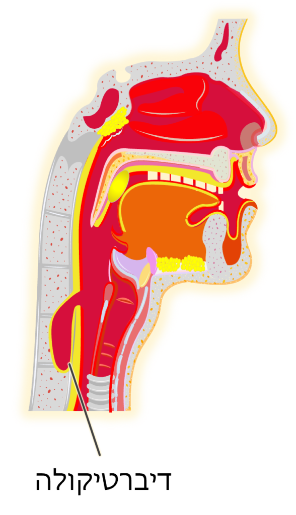 Zenker diverticulum pharynx מחלת סעיף זנקר