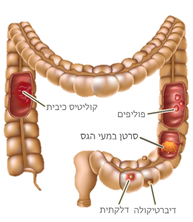 colon cancer colitis diverticula polyp cutouts